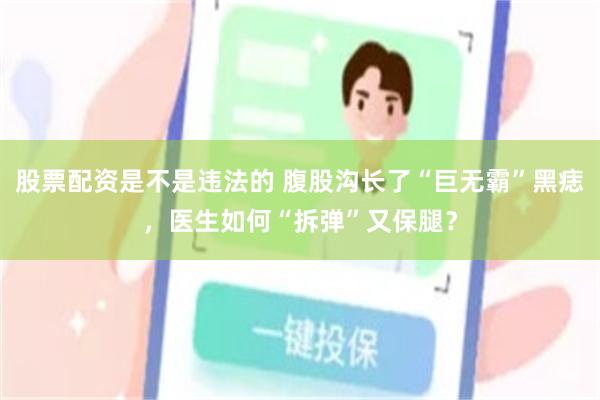 股票配资是不是违法的 腹股沟长了“巨无霸”黑痣，医生如何“拆弹”又保腿？